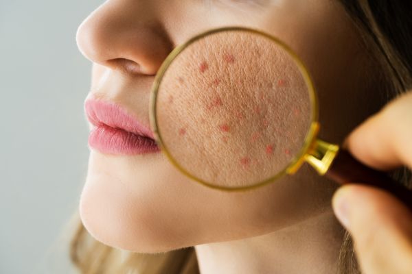 Mujer adulta con acné facial